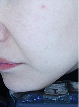 피코슈어플러스+엑셀브이+줌패스