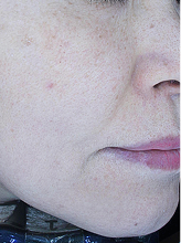 피코슈어+엑셀브이