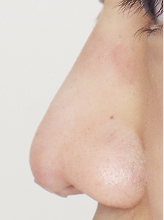 코필러+코실리프팅