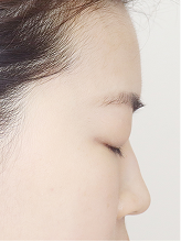 이마필러+코필러