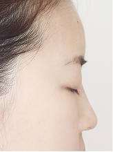 이마필러+코필러