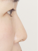 콧대+코끝실리프팅