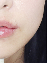 입술필러