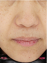 피코슈어/플러스+엑셀브이+줌패스