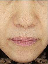 피코슈어/플러스+엑셀브이+줌패스