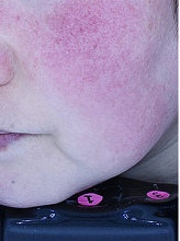 더마v 홍조 2파장+피코플러스+더블제네시스