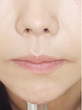 입술필러