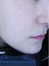 피코슈어+더마리쥬비+더마 홍조2파장