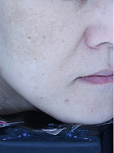 피코슈어+플러스+더블더마제네시스