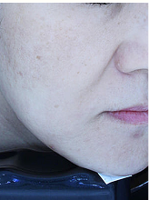 피코슈어+플러스+더블더마제네시스