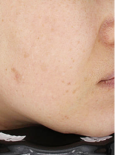 색소 기미+콜라겐레이저